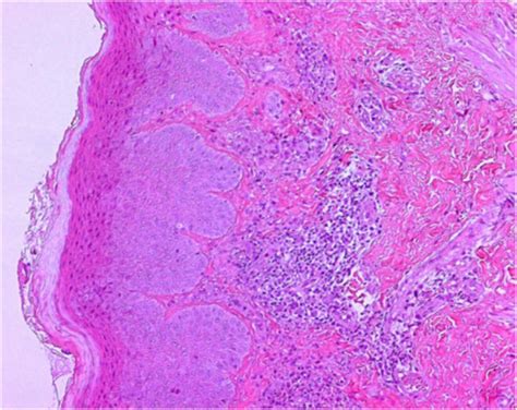 Atopic Dermatitis Histology