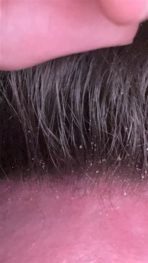 how do i get rid of a hickey asap 1