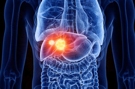 Steatotic liver disease and the link to liver cancer | Roswell Park