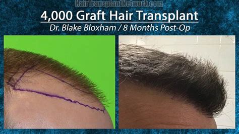 Dr Blake Bloxham Hair Transplant Surgery Before And After Result Images With 4000 Grafts