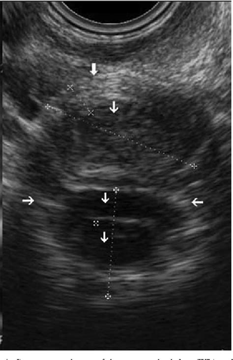 Table 1 From The Role Of Two Dimensional Ultrasonography In The