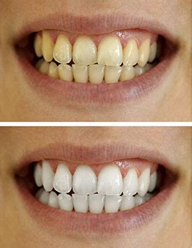 Teeth Whitening Fairfax | Teeth Bleaching | Cosmetic Dentistry