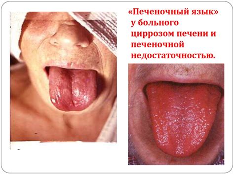 Расспрос больного с заболеванием печени и желчевыводящих путей ...