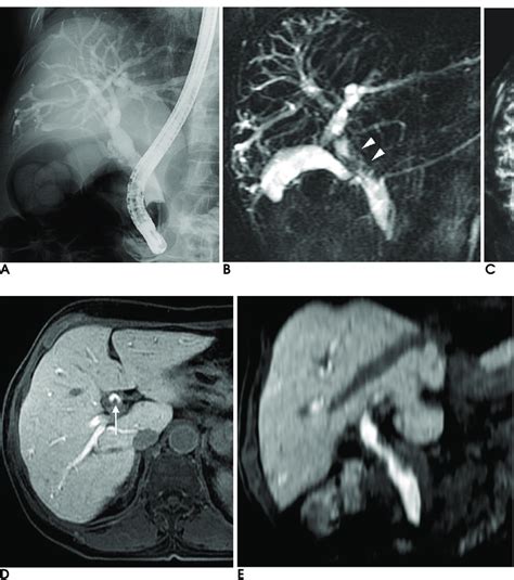 Year Old Female With Intraductal Papillary Cholangiocarcinoma A