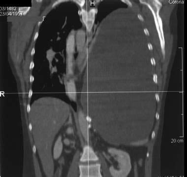 Diaphragmatic Injury Imaging Practice Essentials Radiography