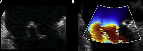 Transesophageal Echocardiographic Evaluation Of A Double Orifice Mitral