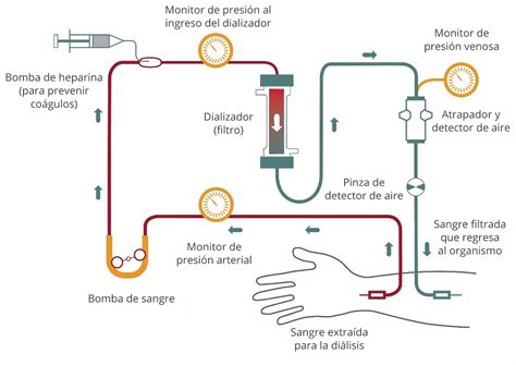 EL CUERPO HUMANO Hemodiálisis qué es