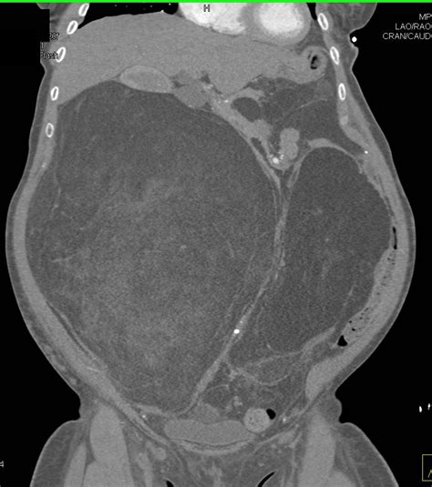 Liposarcoma Gastrointestinal Case Studies Ctisus Ct Scanning