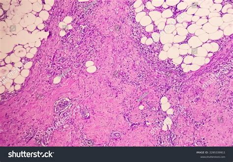 Photomicrograph Granulomatous Tissue Histology Showing Foreign Stock ...