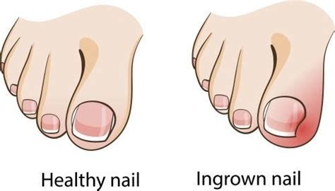 What Is An Ingrown Toenail Including The Top Treatments And Prevention Methods Beltsville Foot