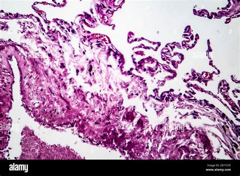 Histopathology Of Lung Emphysema Light Micrograph Photo Under