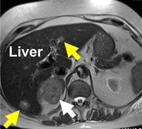 Risk Of Cancer In Adrenal Tumors And Adrenal Masses