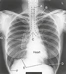 Chest Radiograph Anatomy Diagram | Quizlet