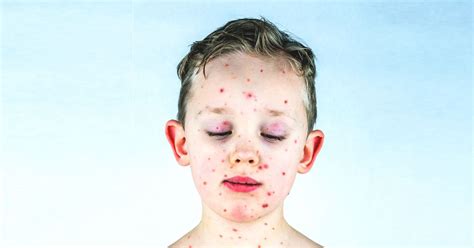 Chickenpox Prevention How To Avoid The Varicella Zoster Virus