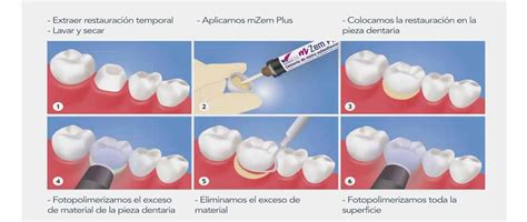 Cementación provisional de acrílico qué es y cómo se realiza POLISANTAFE