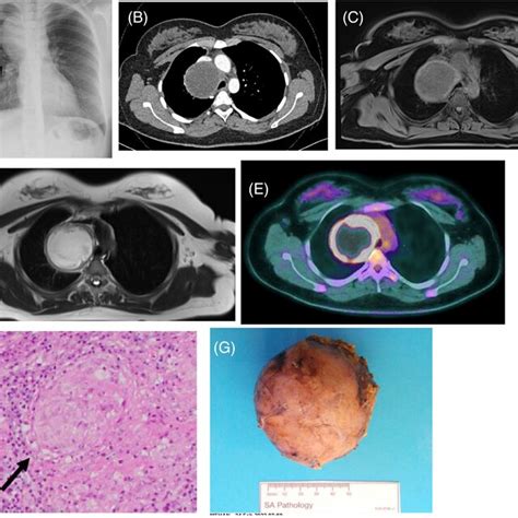 A Chest X‐ray—right‐sided Mediastinal Mass B Computed Tomography Download Scientific