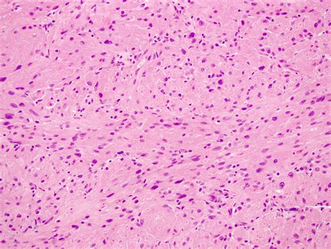 Granular Cell Tumor Histology