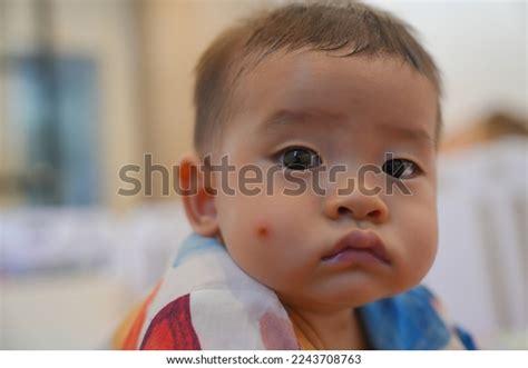 Skin Rash Allergy Red Spot Cause Stock Photo 2243708763 | Shutterstock