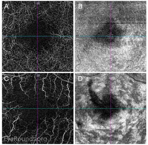 Paracentral Acute Middle Maculopathy PAMM