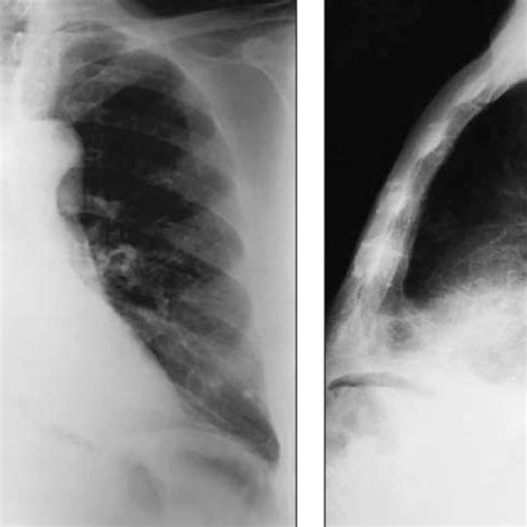 Radiografias De T Rax Em P Stero Anterior A E Perfil B Demonstrando