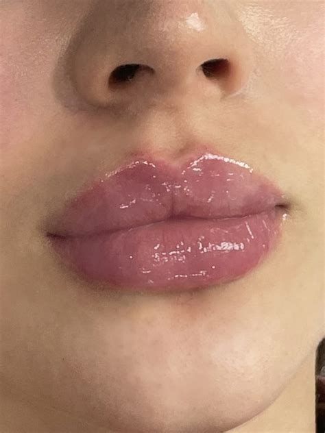 Lip Filler Near Me