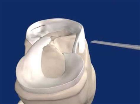 Fast Fix Meniscal Repair Youtube