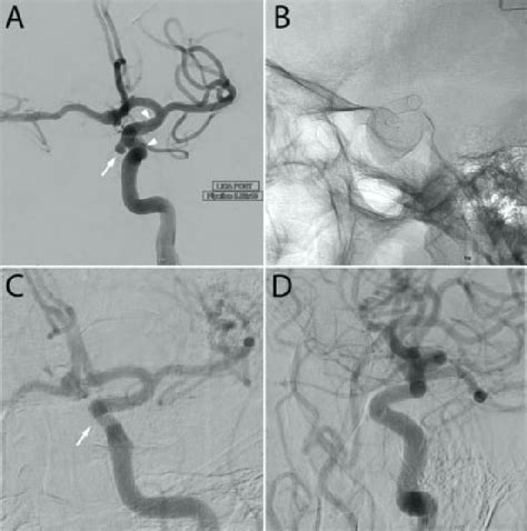 Diagnostic Cerebral Angiogram Demonstrating Complete Occlusion Of A