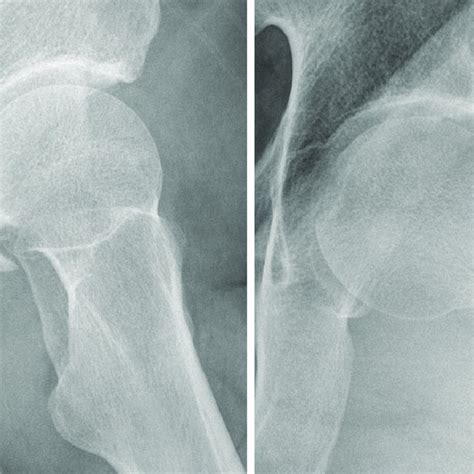 Acetabular Labrum Anatomy Human Anatomy B