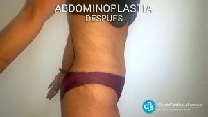 Abdominoplastia Despues La Serena Cirug A Pl Stica La Serena