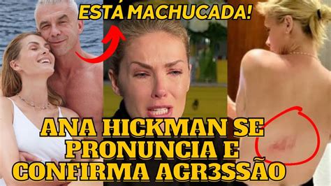 Ana Hickman Se Pronuncia E Confirma Agr Ss O Do Marido Ap S Ele Negar