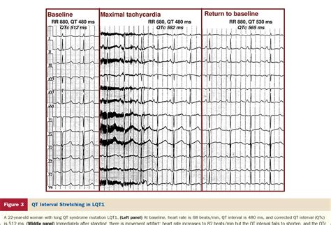 Figure 3 from The response of the QT interval to the brief tachycardia ...