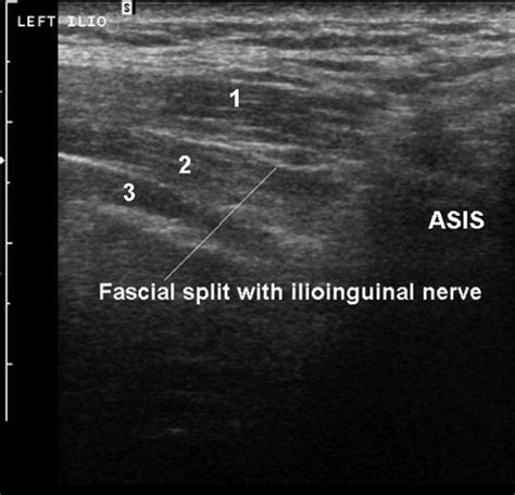 Inguinal Nerve Block