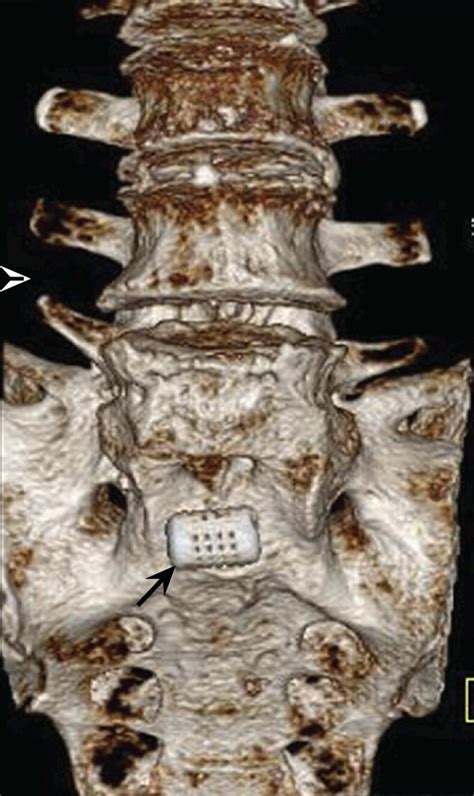 Examples Of Migration Of Spinal Hardware At The Lumbar And Cervical