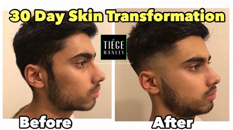 30 Day Honest Skin Transformation Review With Tiege Hanley For Men