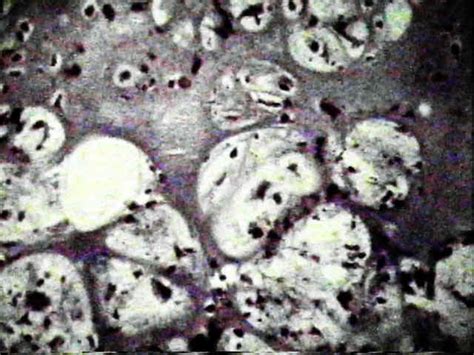 Histology of Chondrosarcoma : Wheeless' Textbook of Orthopaedics