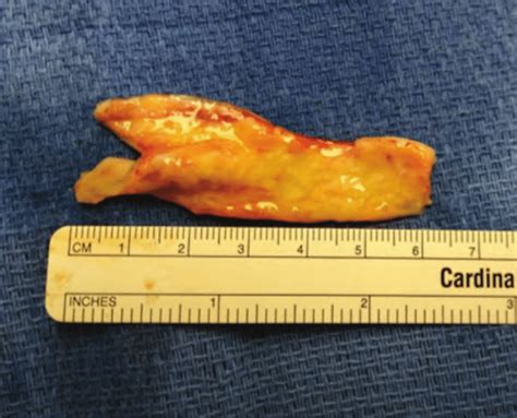 Example of a large buccal mucosal graft used for urethroplasty ...