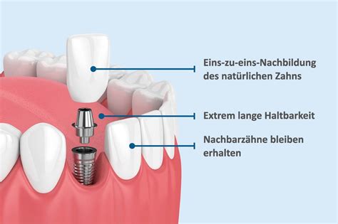 Zahnimplantat Stuttgart Im Alldent Implantatzentrum