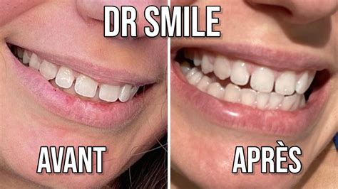 Mon Avis Sur Dr Smile En Milieu De Traitement Youtube