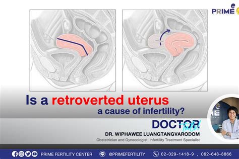 Retroverted Uterus Pregnancy Ultrasound