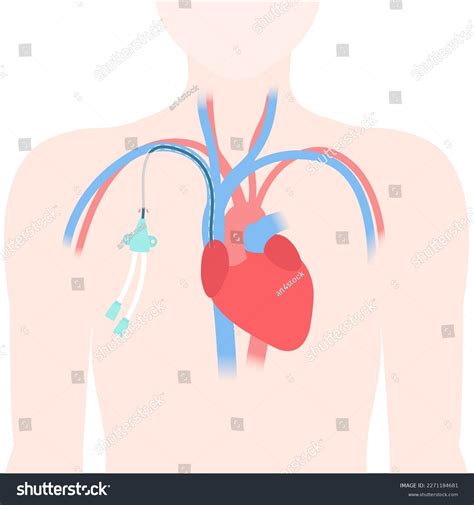 Tunneled Central Venous Catheter Placed Subclavian เวกเตอร์สต็อก ปลอด