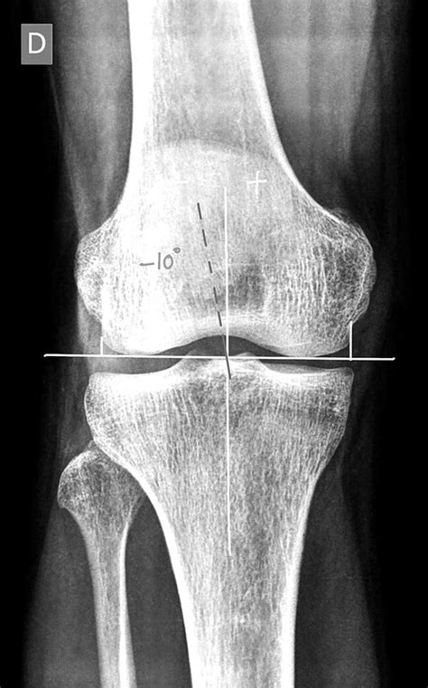 Petr Leo L Rico Maor Como Interpretar Una Radiografia De Rodilla