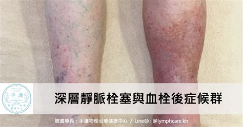 手護物理治療健康中心 深層靜脈栓塞dvt與血栓後症候群pts