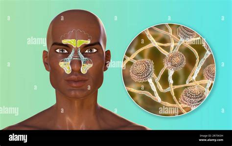 Aspergillus Fungi As A Cause Of Sinusitis Computer Illustration