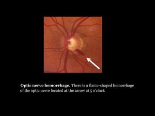 Optic nerve Diseases By: Sumayya Naseem Optometrist | PPT