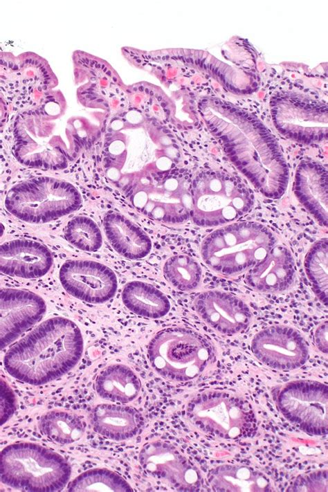 Intestinal Metaplasia Of The Stomach Libre Pathology