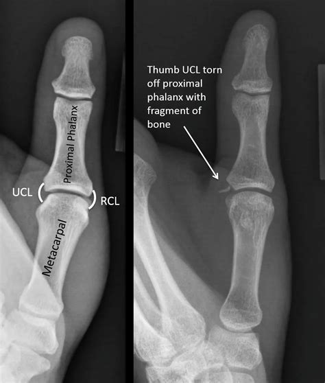 Thumb Collateral Ligament Injury Symptoms Treatment