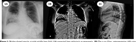 Figure From Nocardial Vertebral Osteomyelitis And Epidural Abscess Of