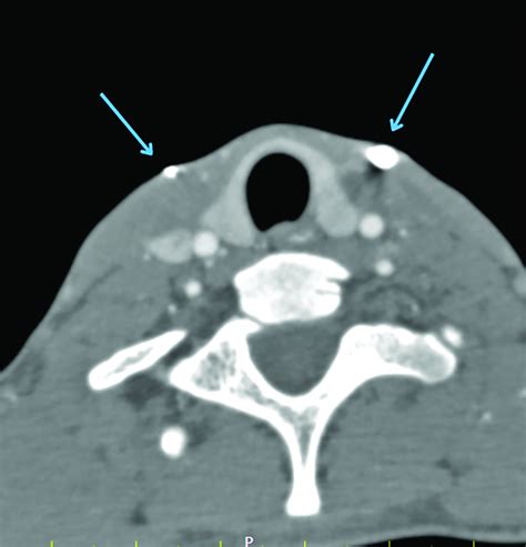 Congenital Branchial Cleft Cyst 6