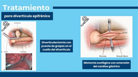 Divert Culos Esof Gicos S Ntomas Y Tratamiento Ppt