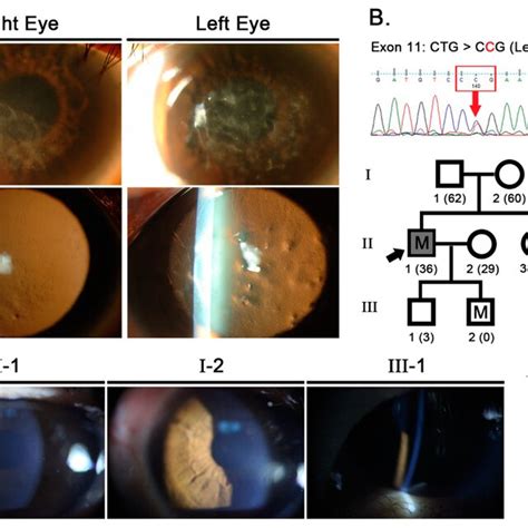 Slit Lamp Photographs And Molecular Genetic Analyses A Slit Lamp